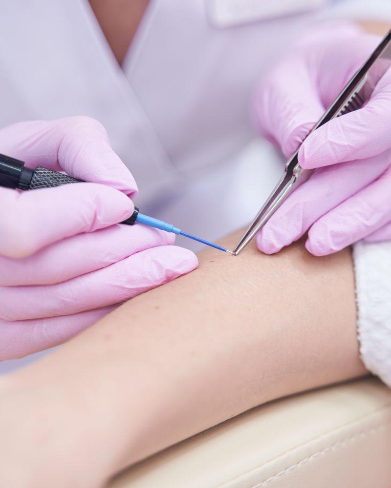Electrocautery photo 01