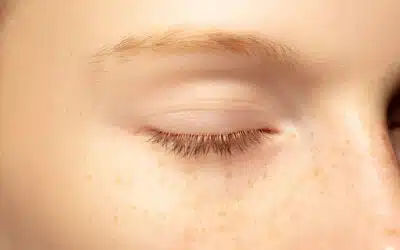 What is Milia? (And How to Get Rid of It)