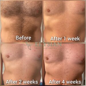 laser hair removal before and after