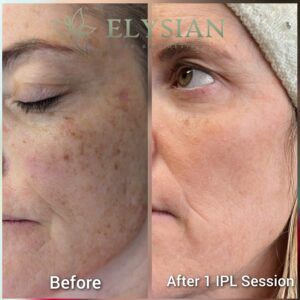 IPL photofacia Before and After BM