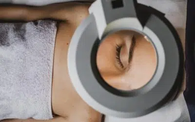 IPL Photofacial Before and After