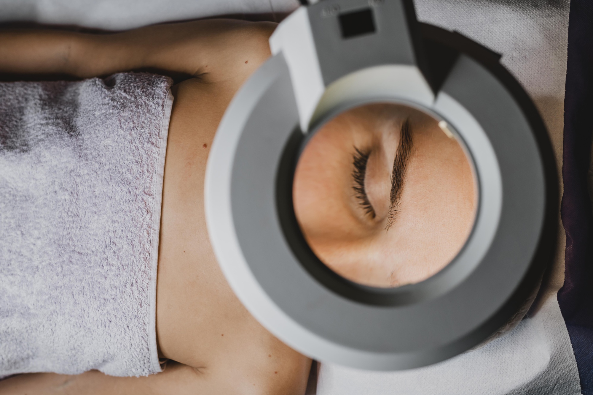 ipl treatment