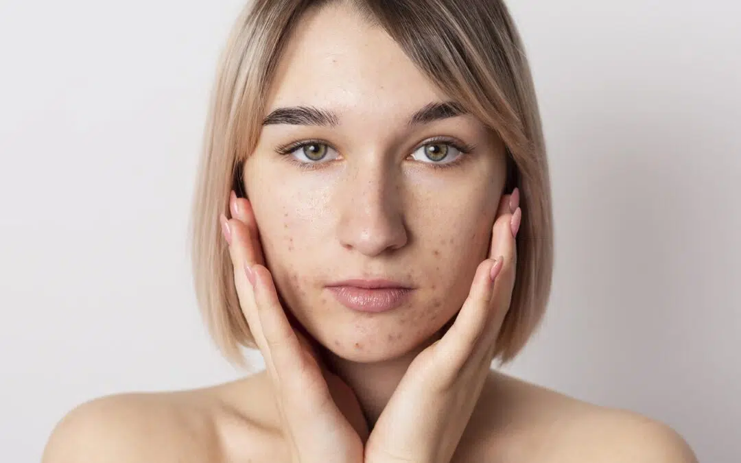 How to Get Rid of Acne Scars: Proven Treatments and Tips
