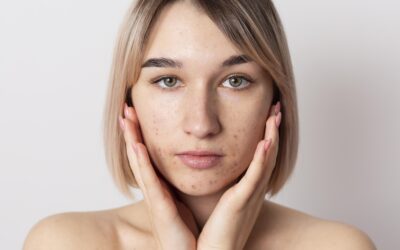 How to Get Rid of Acne Scars: Proven Treatments and Tips