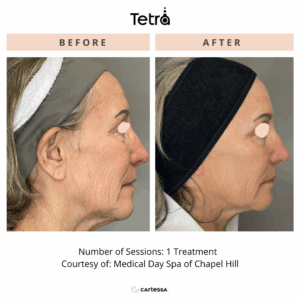 Laser Skin Tightening 