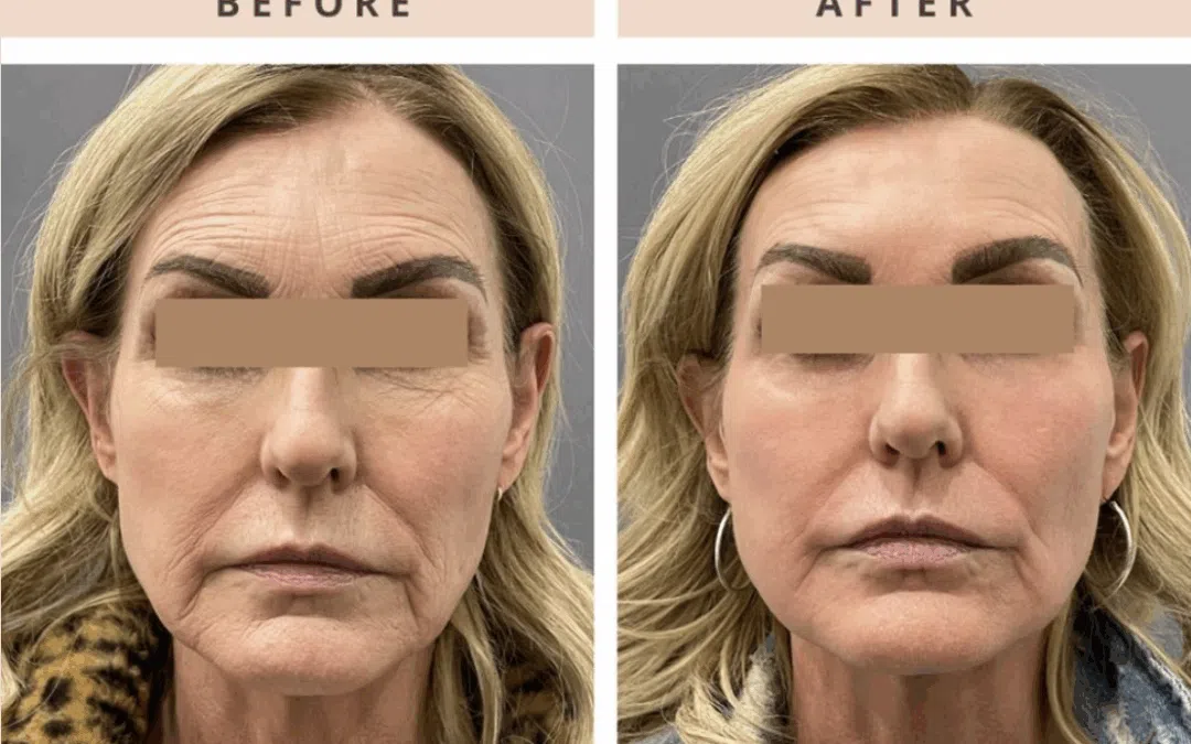 Laser CO2 Resurfacing Before and After: What to Really Expect