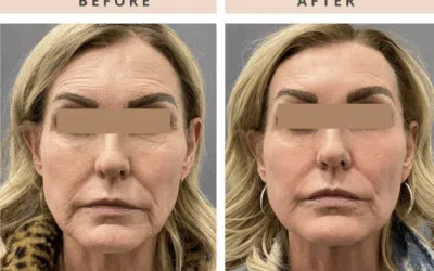 Laser CO2 Resurfacing Before and After: What to Really Expect