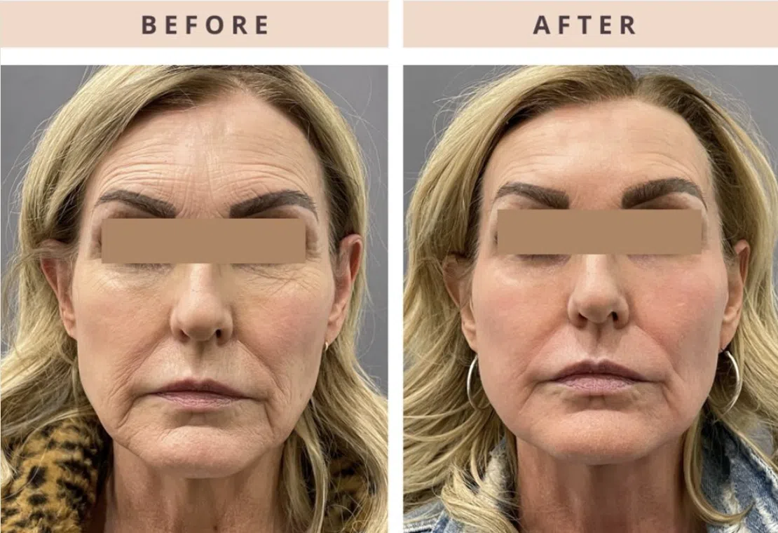 Laser CO2 Resurfacing Before and After Laser CO2 Resurfacing Before and After