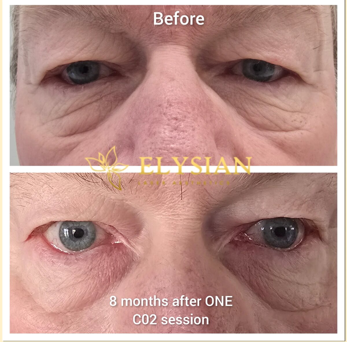 CO2 laser Calgary eyelid tightening - Deka treatment results - 8 months post-treatment
