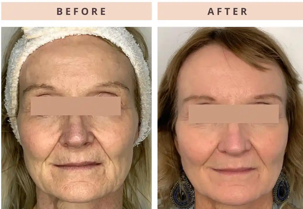 Elluminate trmt Elluminate trmt