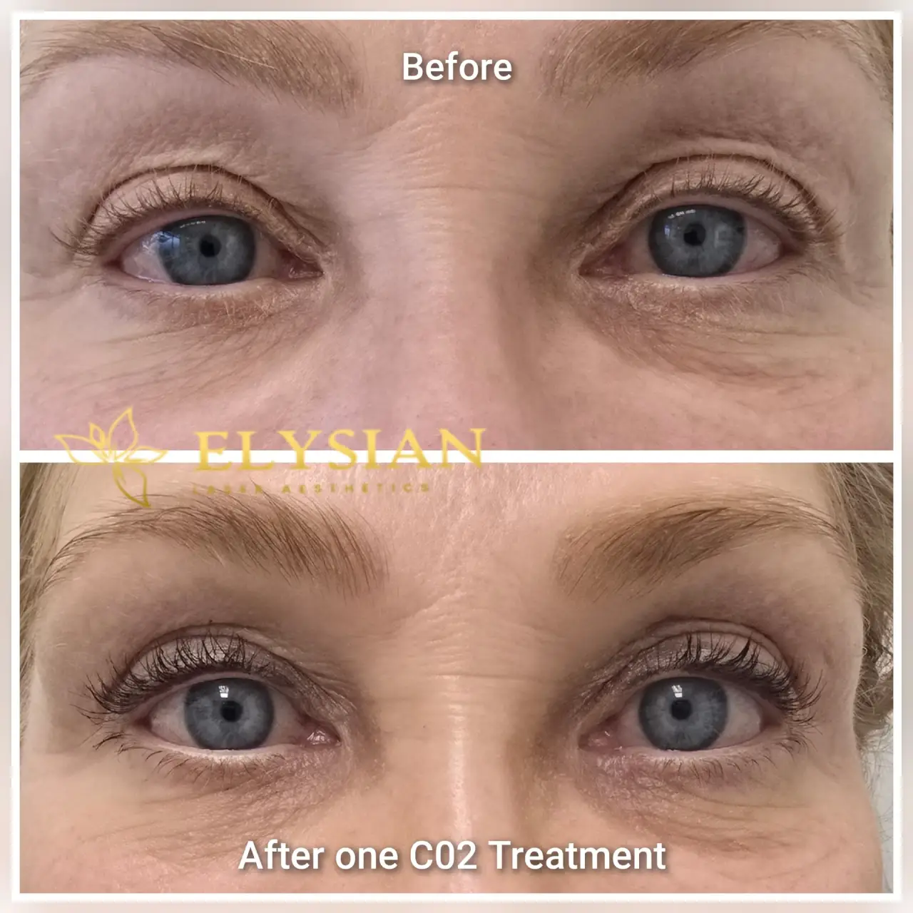 CO2 Laser Eyelid Tightening Calgary