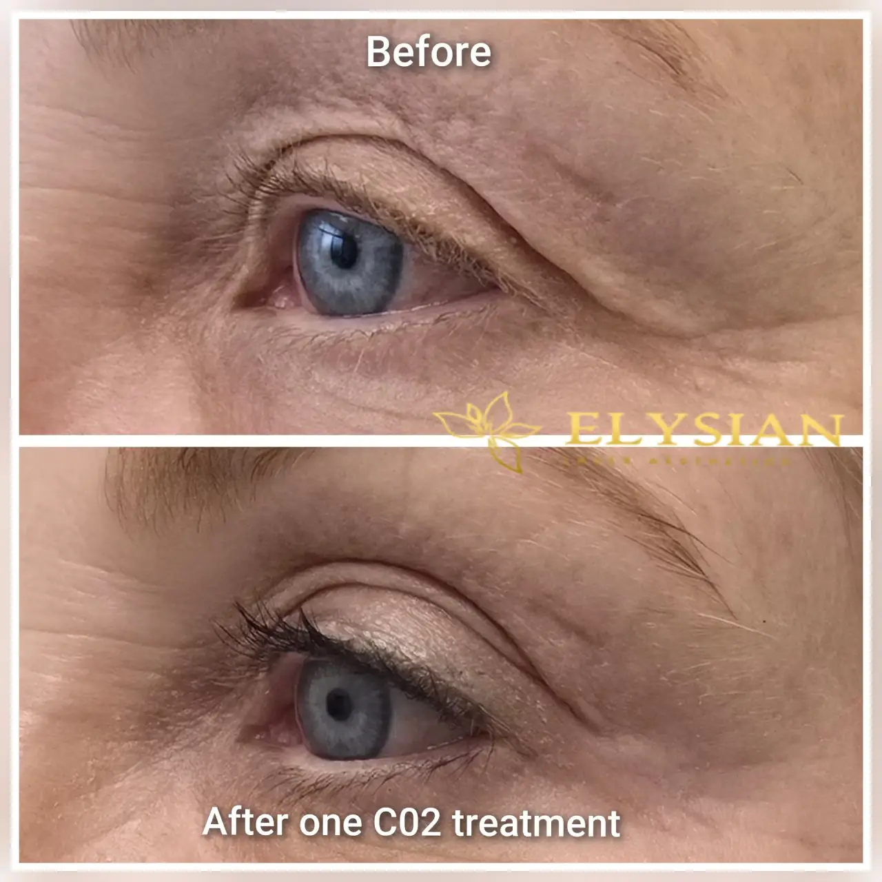 CO2 Laser Eyelid Tightening Calgary