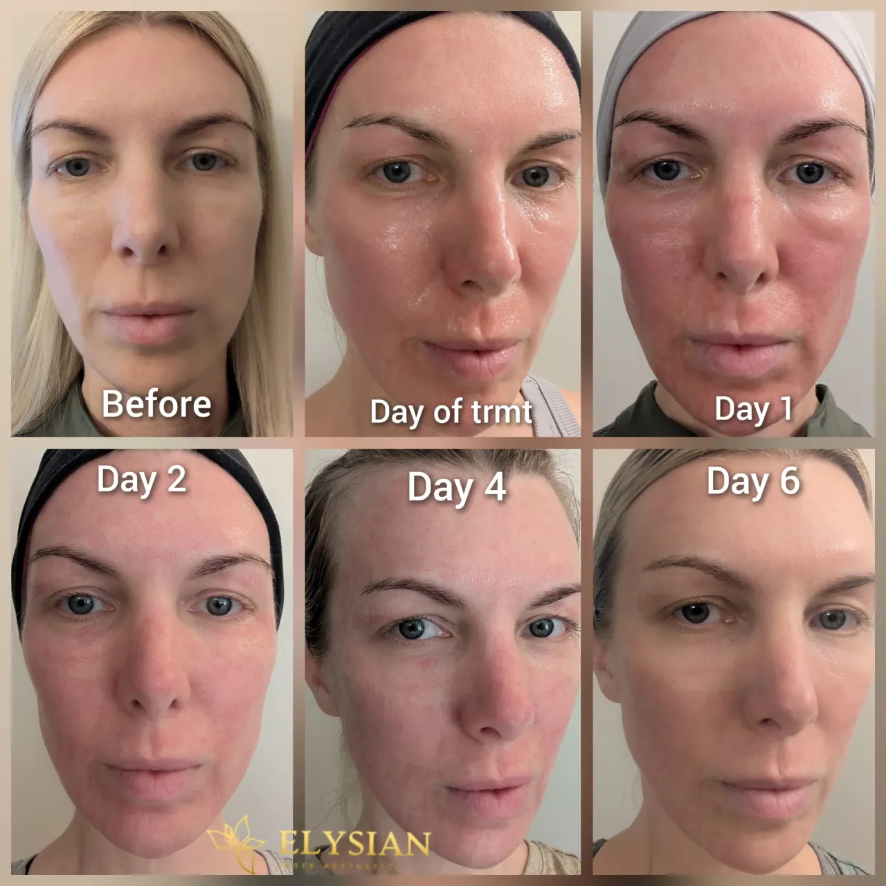 Best Time for CO2 Laser in Calgary