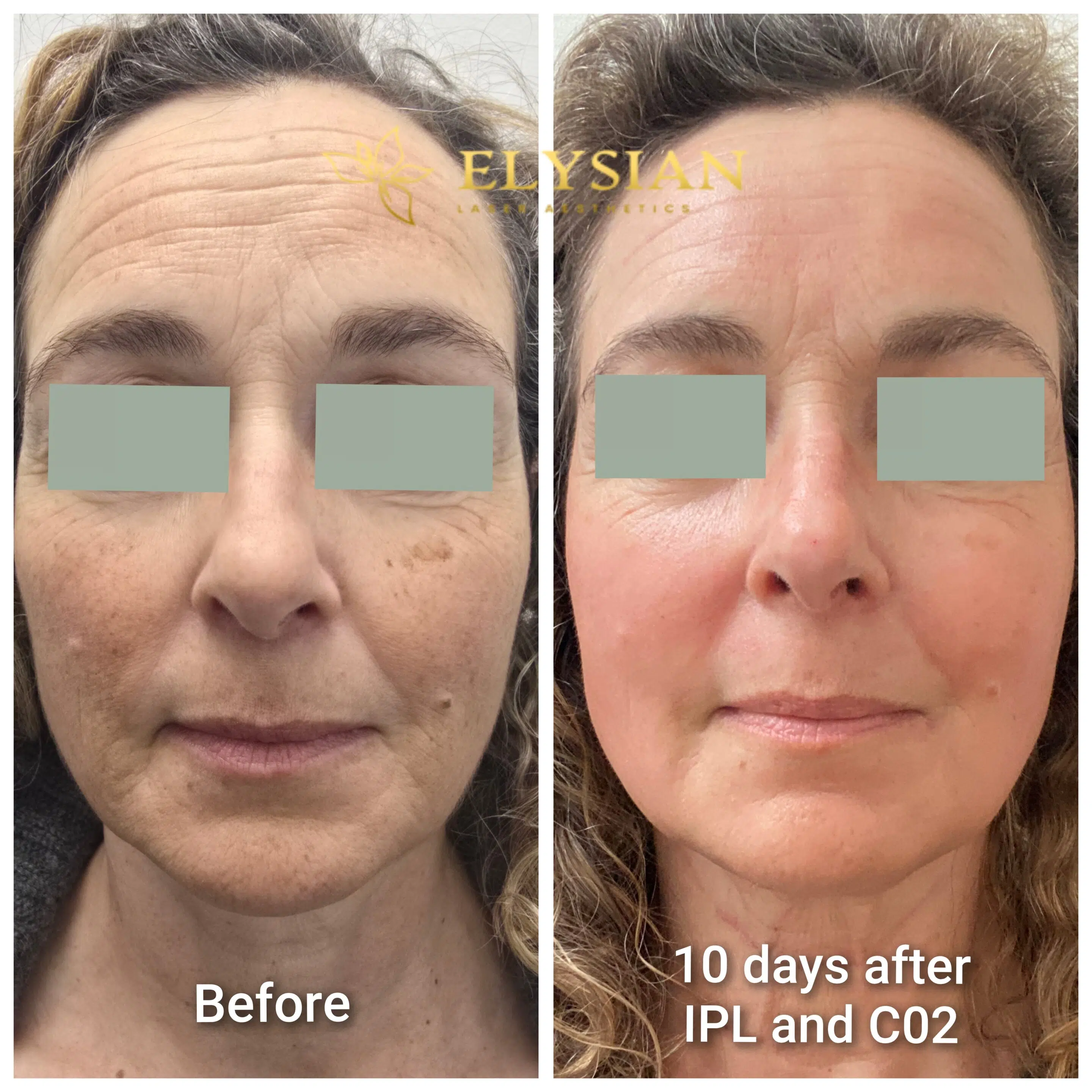 IPL and Deep CO2 Laser Before and After – 10 Days Post Treatment Calgary Before and after IPL and deep CO2 laser treatment showing improved skin tone and texture at 10 days post-treatment at Elysian Laser Aesthetics Calgary