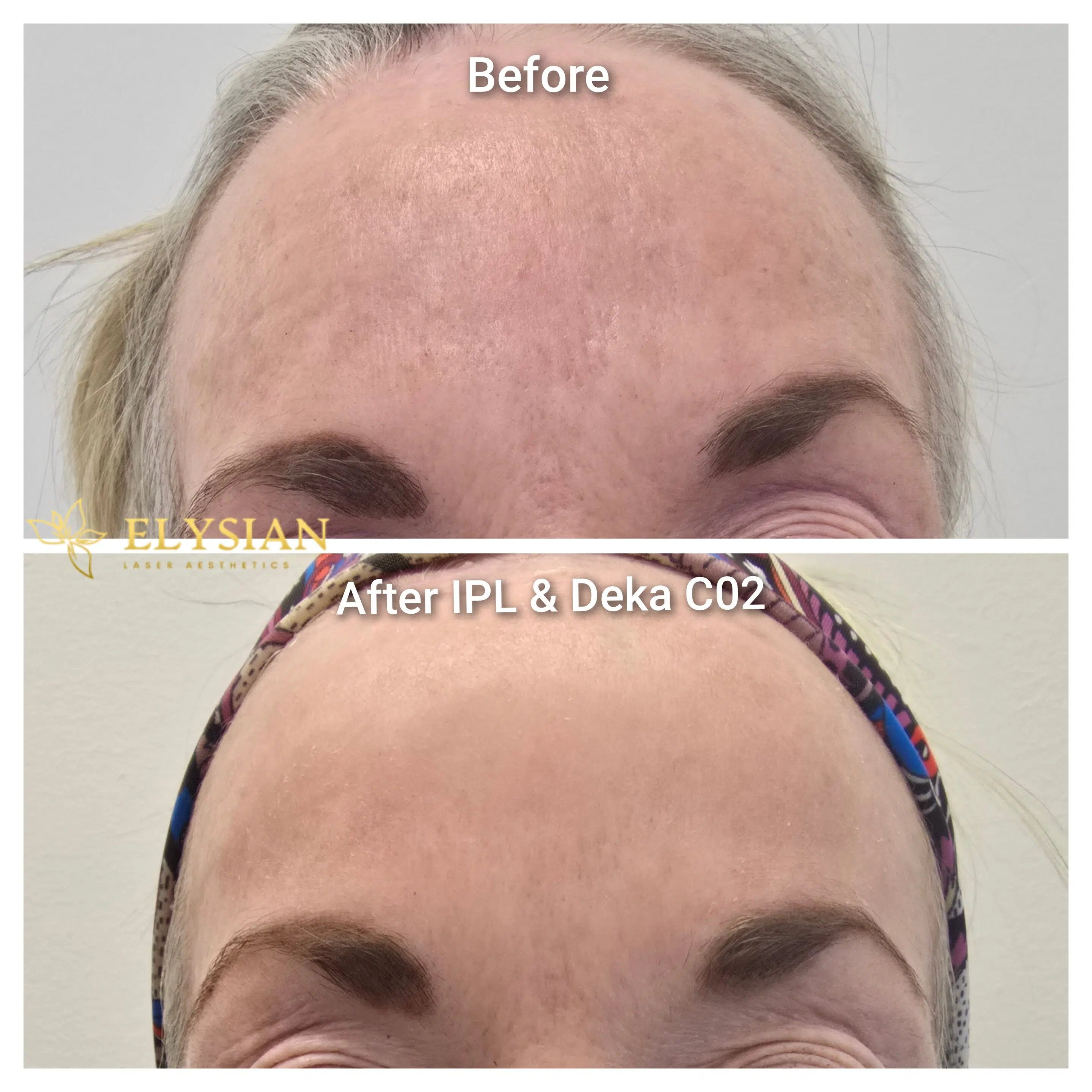 Deep CO2 Laser Before and After Forehead – Pigmentation and Texture Calgary Before and after deep CO2 laser treatment on forehead showing reduced pigmentation and smoother skin texture at one month post-treatment at Elysian Laser Aesthetics Calgary