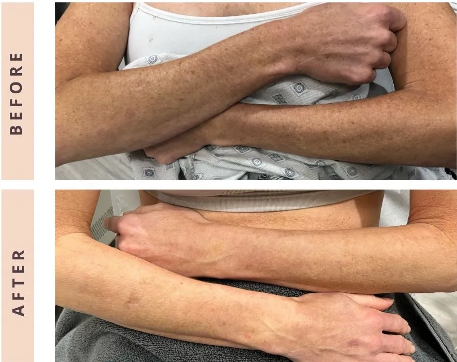 Pigment arms Pigmentation, Broken Vessels & Skin Rejuvenation in Calgary