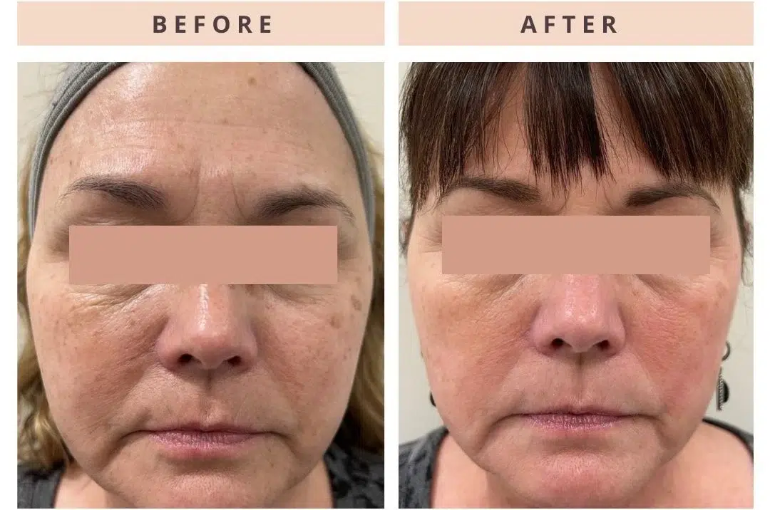 Pigment treatment Pigment treatment