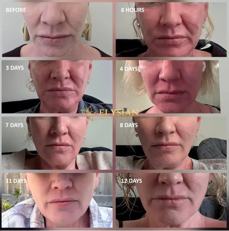 co2 laser healing timeline day by day recovery