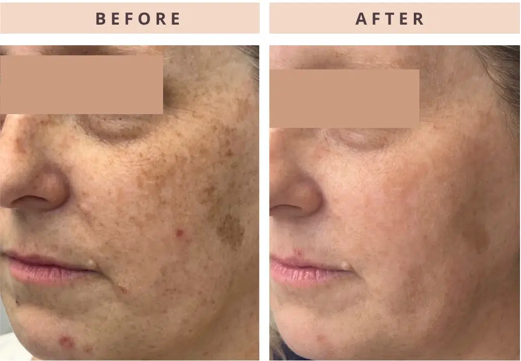 IPL Photofacial Before & After Results — Calgary Clients IPL Photofacial Before & After Results — Calgary Clients