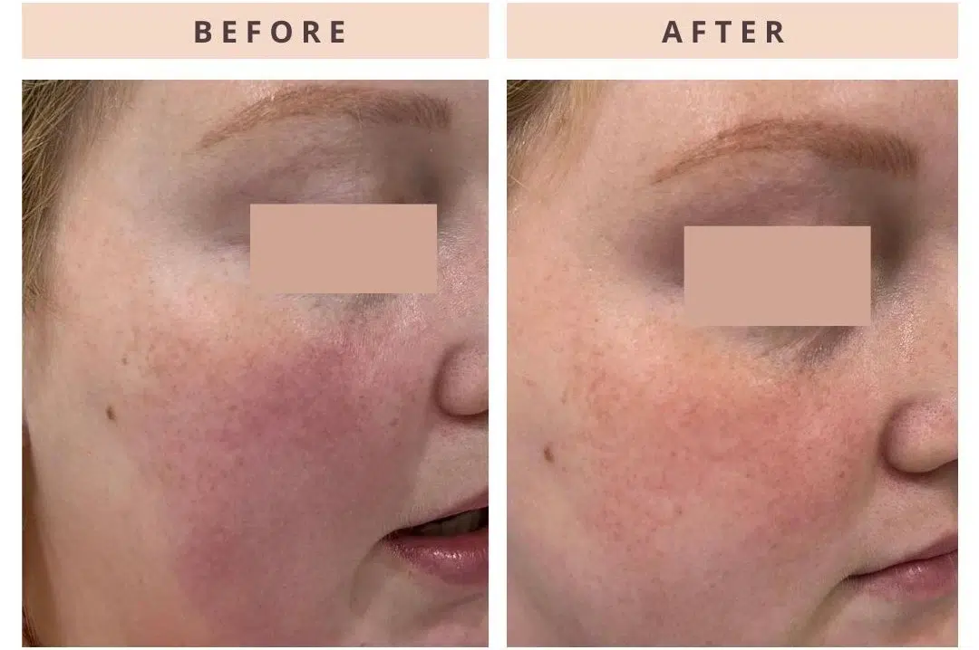 IPL Photofacial IPL Photofacial