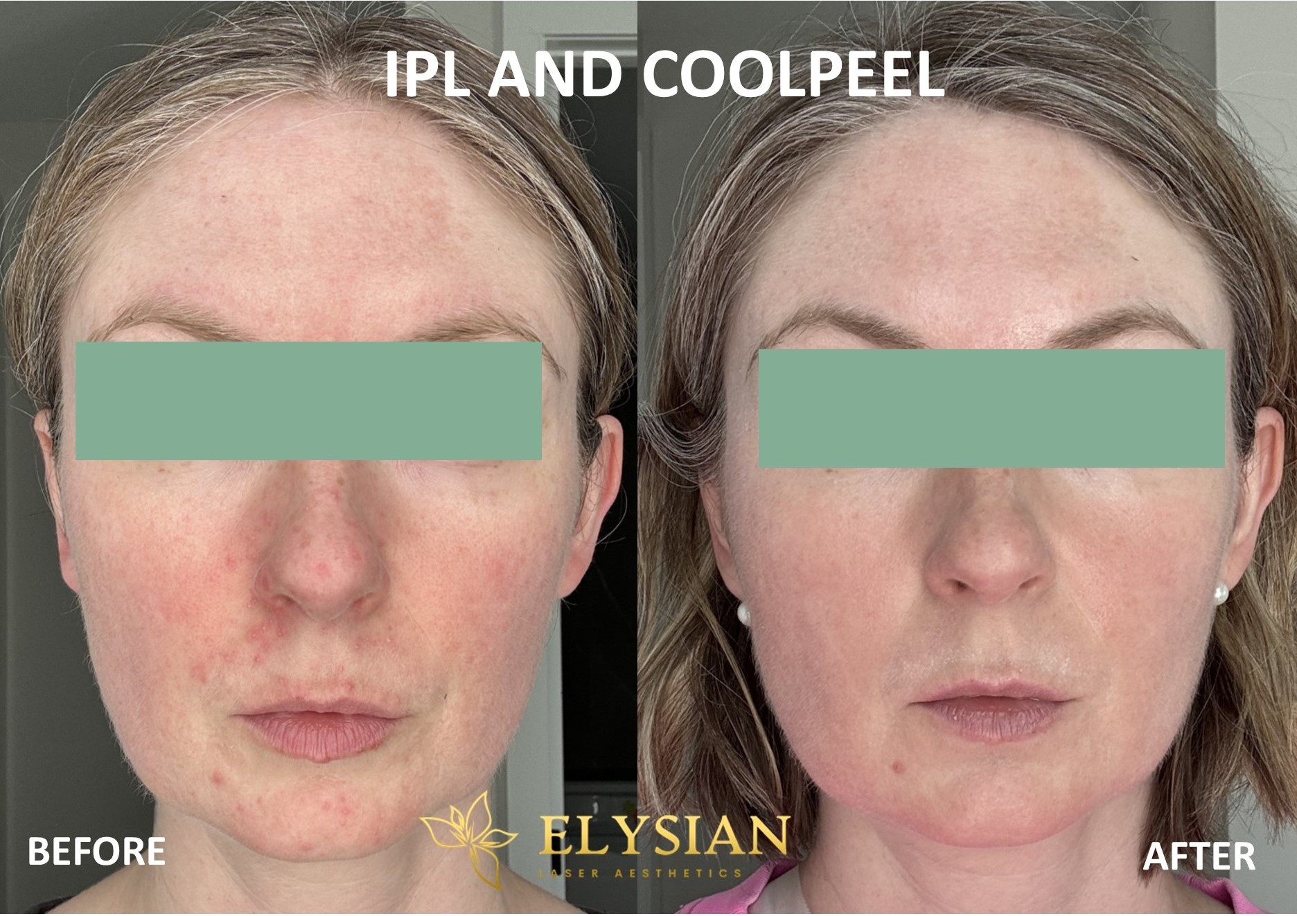 Laser Aesthetic Treatments in Calgary 1 coolpeel BEFORE AND AFTER