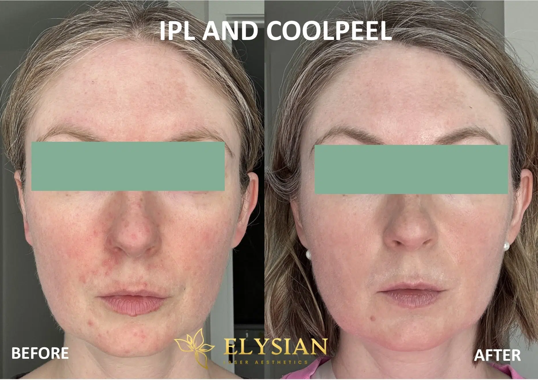 Laser Aesthetic Treatments in Calgary 1 coolpeel BEFORE AND AFTER