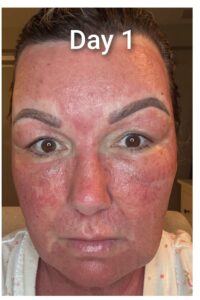 co2 recovery day 1 co2 recovery day 1