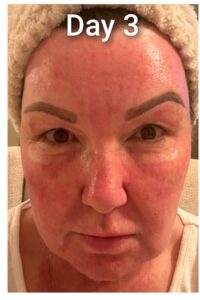 co2 recovery day 3 co2 recovery day 3