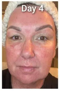 co2 recovery day 4 co2 recovery day 4