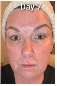 co2 recovery day 7 co2 recovery day 7