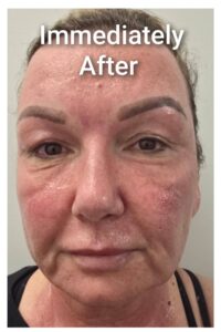 co2 recovery immediately after