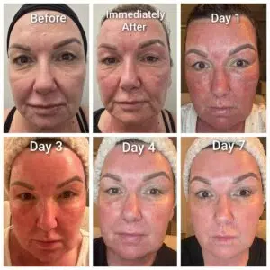 deka tetra co2 recovery timeline