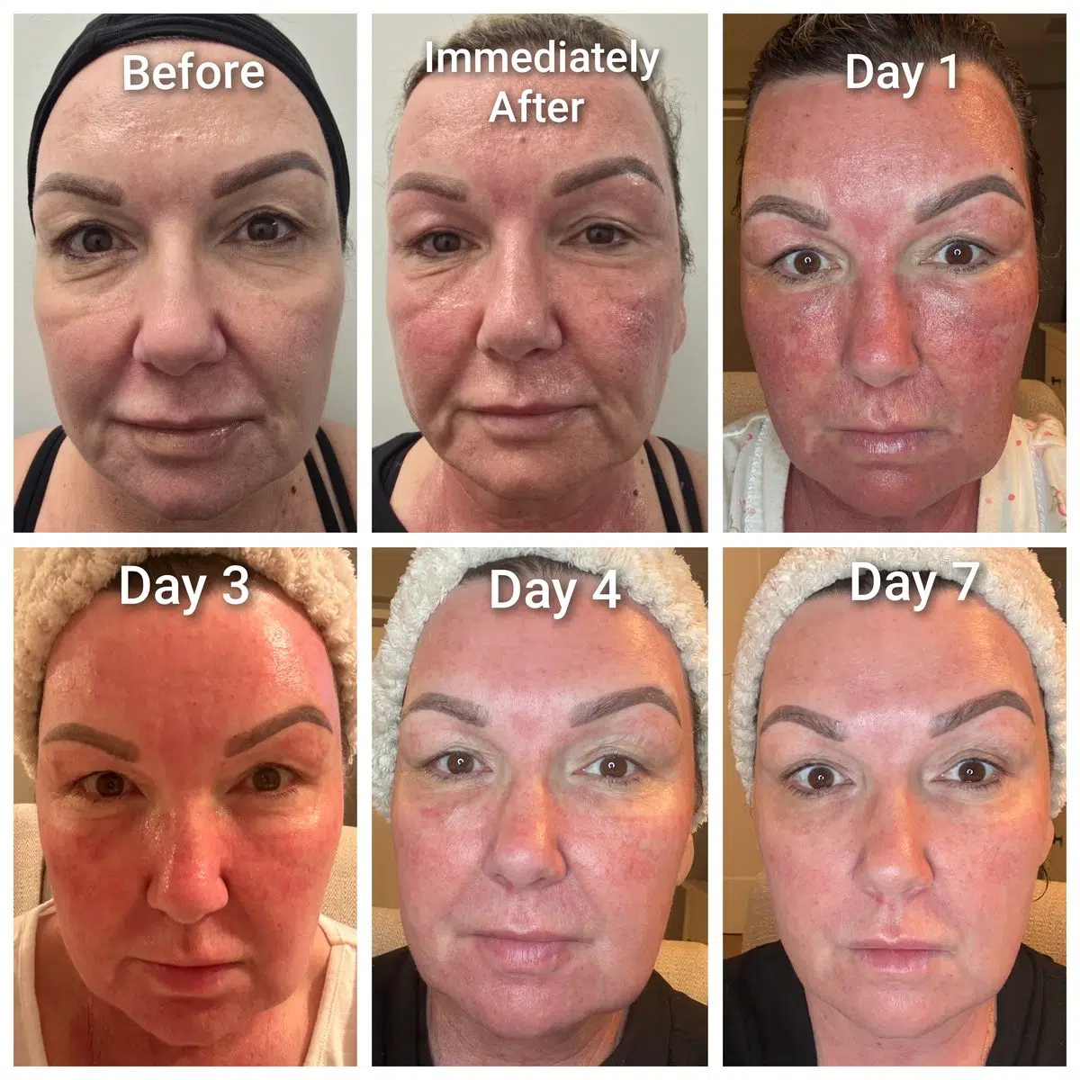 deka tetra co2 recovery timeline Elysian Laser