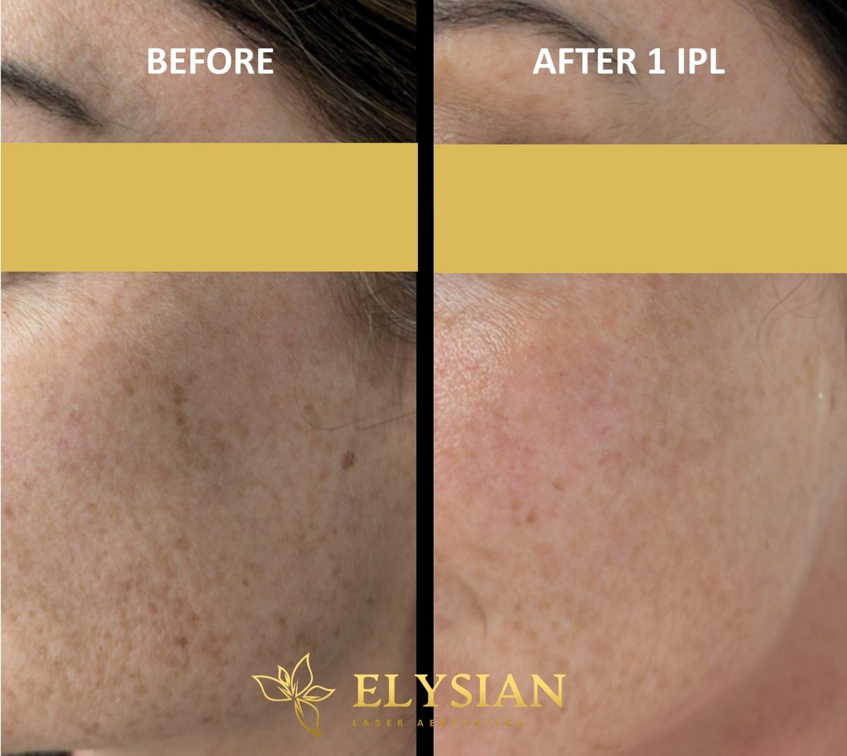 Laser Aesthetic Treatments in Calgary 2 Before and after one IPL photofacial treatment at Elysian Laser Aesthetics in SE Calgary — significant reduction in sun spots and skin tone evening after a single session