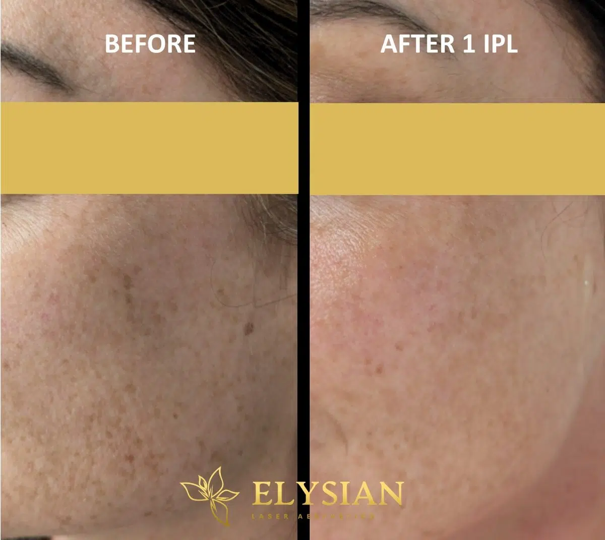 Laser Aesthetic Treatments in Calgary 2 Before and after one IPL photofacial treatment at Elysian Laser Aesthetics in SE Calgary — significant reduction in sun spots and skin tone evening after a single session