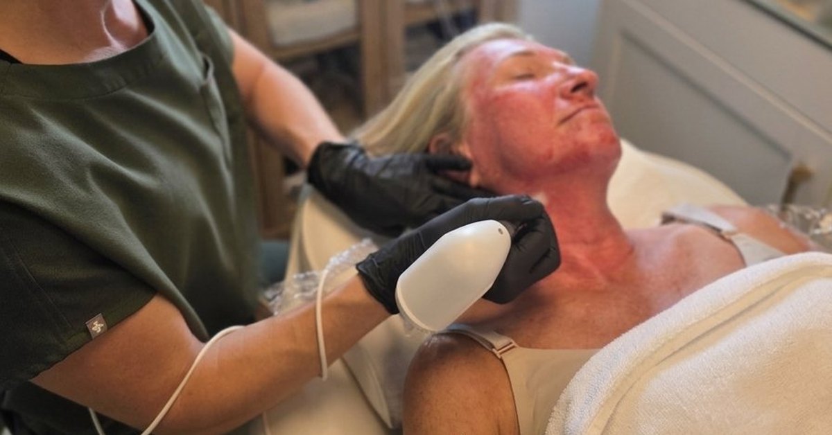 Microneedling Calgary client showing normal redness during treatment at Elysian Laser Aesthetics