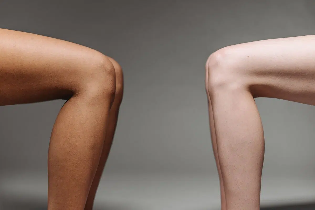 Smooth legs on light and dark skin tones, illustrating Brazilian laser hair removal sessions for all skin tones