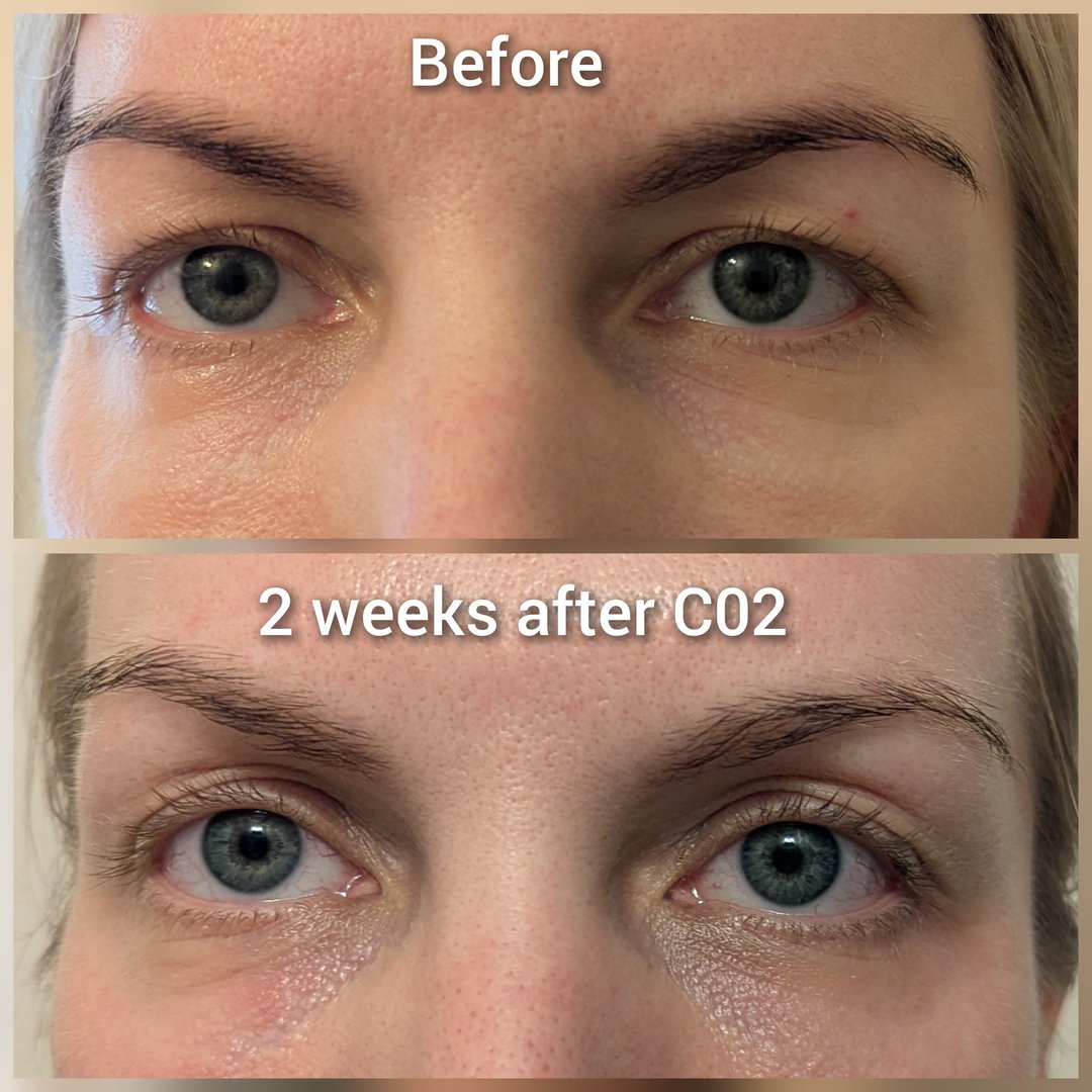 CO2 laser eyelid tightening blepharoplasty alternative before and after - 2 weeks result Calgary