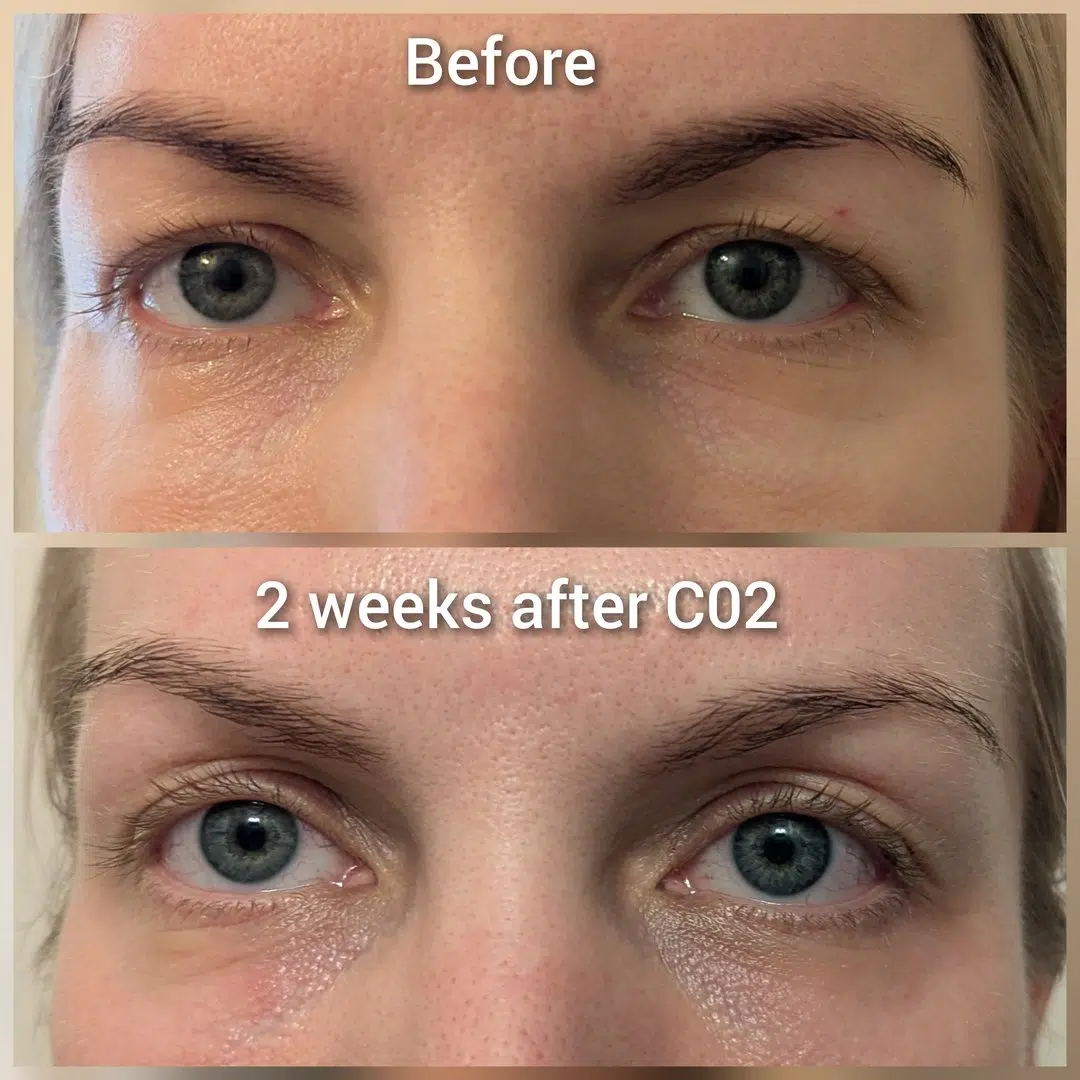 CO2 eyelid tightening before and after 2 weeks CO2 laser eyelid tightening blepharoplasty alternative before and after - 2 weeks result Calgary