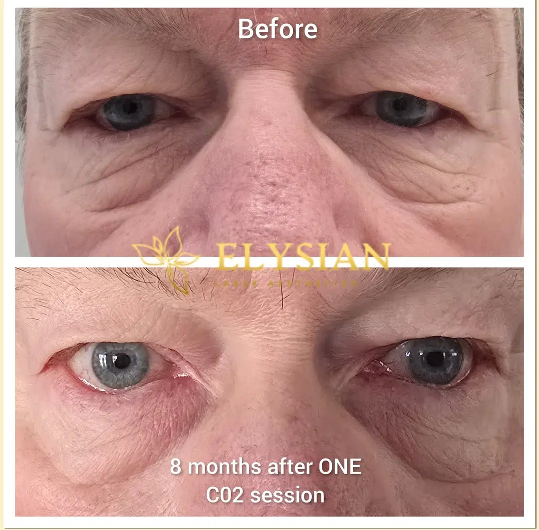 Laser Aesthetic Treatments in Calgary 10 CO2 eyelid tightening Calgary - calming sage-green spa flat-lay at Elysian Laser Aesthetics
