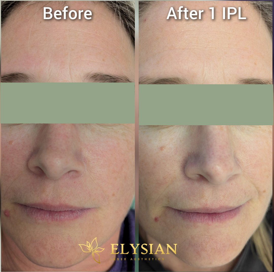 Before and after one IPL photofacial in Calgary showing reduced facial redness and more even skin tone