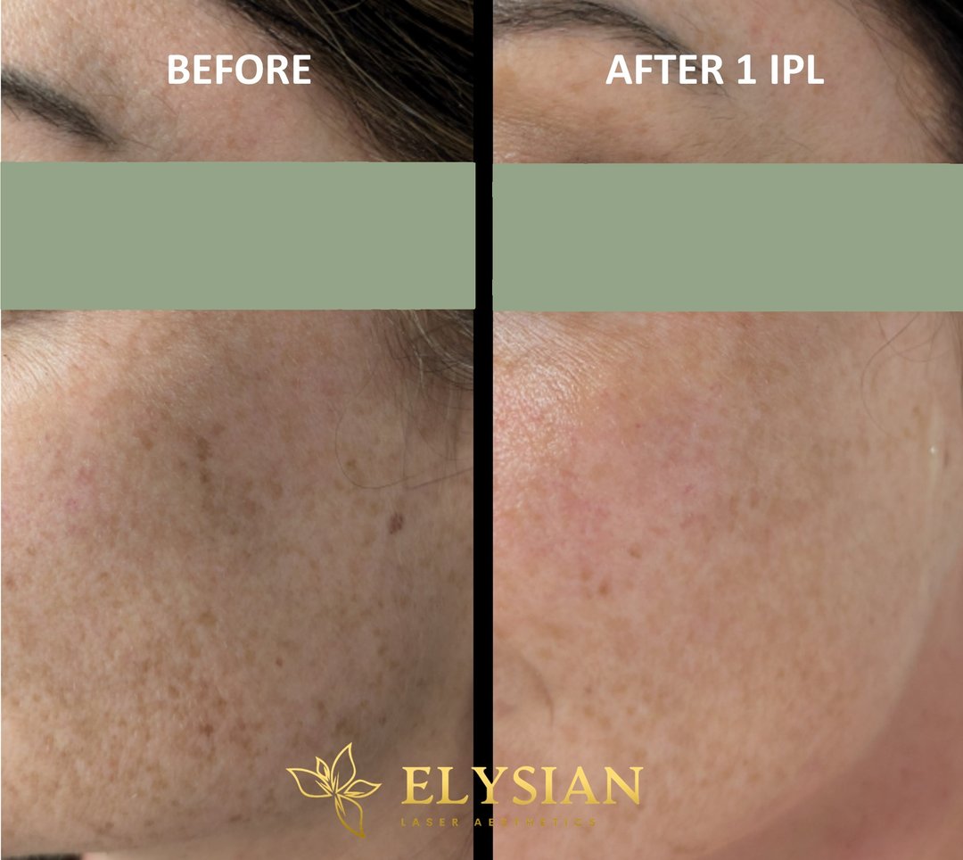 IPL photofacial Calgary before and after — reduced sun damage and pigmentation after one treatment