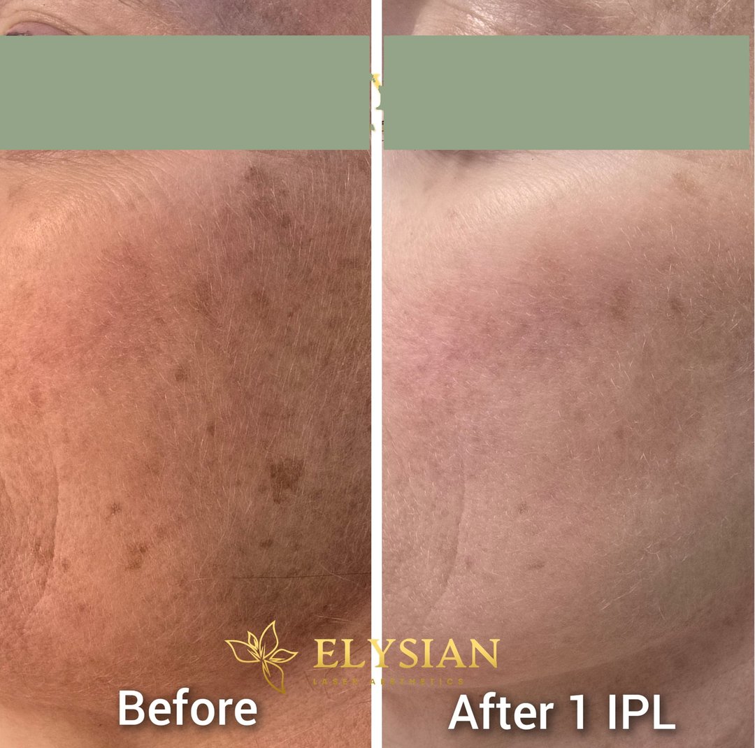 IPL photofacial Calgary before and after — brown sun spots faded across the cheek after a single session