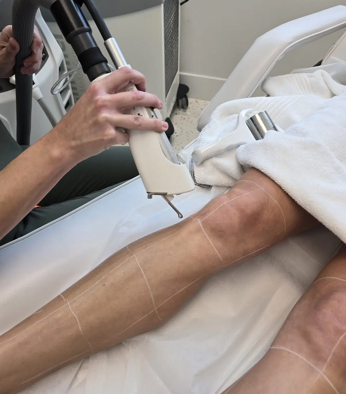 Leg Laser Hair Removal Calgary — Permanent Results, All Skin Types 1 Leg laser hair removal in Calgary using the Quanta EVO at Elysian Laser Aesthetics