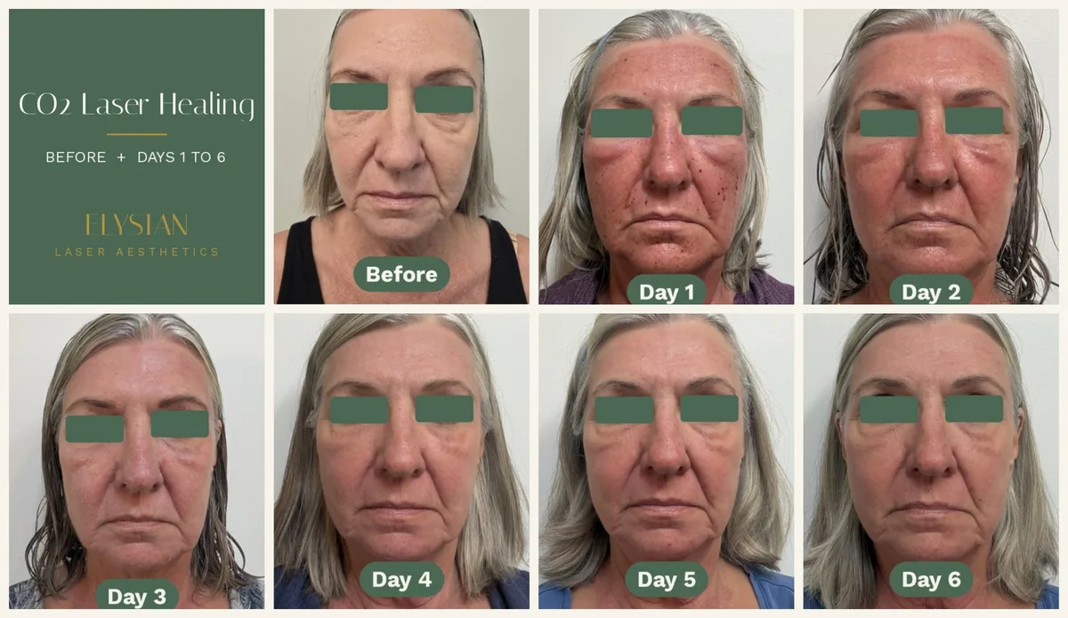 Halo vs CO2 Laser: Which One Fits Your Skin? 1 Halo vs CO2 laser downtime: real Deka Tetra CO2 healing photos from before treatment through day 6 in Calgary